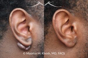 Photo of a patient before and after a procedure. Keloid of the Right Earlobe - Keloid was successfully removed during an office procedure in the office. The earlobe is now perfectly normal looking.