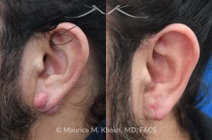 Photo of a patient before and after a procedure. Left Earlobe Keloid Excision - Left earlobe keloid excision performed in the office under local anesthesia. 
