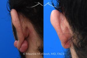 Photo of a patient before and after a procedure. Left Earlobe Keloid Excision - Left earlobe keloid excision performed in the office under local anesthesia. 

