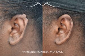 Photo of a patient before and after a procedure. Keloid Scar on Upper Left Ear  - photo before and after removal.