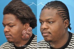 Photo of a patient before and after a procedure. Keloid Ear - before and after treatment results.