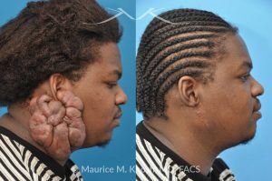 Photo of a patient before and after a procedure. Keloid Ear - before and after treatment results.