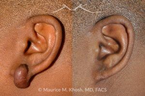 Photo of a patient before and after a procedure. Keloid Earlobe - before and after treatment results.