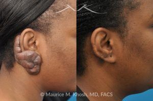 Photo of a patient before and after a procedure. Keloid Earlobe - before and after treatment results.