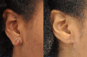 Photo of a patient before and after a procedure. Keloid of Earlobe, Excision and Repair of Keloid - before and after treatment results.