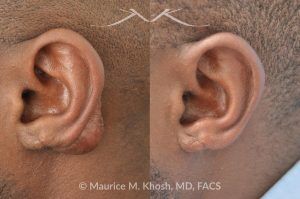 Photo of a patient before and after a procedure. Keloid Scar of Left Ear (Auricle) - Excision and Repair of Ear Keloid: Before and After Treatment Results