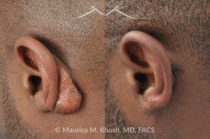 Photo of a patient before and after a procedure. Keloid Scar of Left Ear (Auricle) - Excision and Repair of Ear Keloid: Before and After Treatment Results