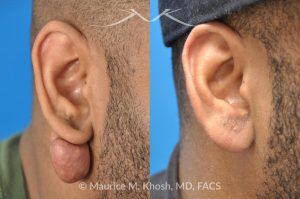 Photo of a patient before and after a procedure. Keloid Scar Removal, Right Earlobe - before and after treatment results.