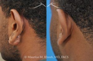 Photo of a patient before and after a procedure. Keloid of Left Ear - before and after treatment results.