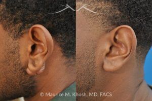 Photo of a patient before and after a procedure. Keloid of Left Ear - before and after treatment results.
