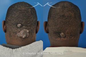 Photo of a patient before and after a procedure. Scalp Keloid from Acne - treatment results.