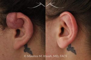 Photo of a patient before and after a procedure. Keloid on Upper Left Ear from Piercing - before and after treatment.