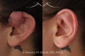 Photo of a patient before and after a procedure. Keloid on Upper Left Ear from Piercing - before and after treatment.