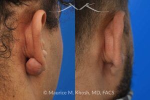Photo of a patient before and after a procedure. Keloid-Free Earlobe Restoration - This 30 year old complained of developing a keloid scar on his earlobe following ear piercing. Keloid surgery in Manhattan office, followed by a series of injections resulted in complete restoration of the natural appearing earlobe.