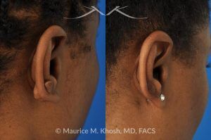 Photo of a patient before and after a procedure. Large Earlobe Keloid Removal - before and after treatment results.