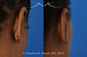 Photo of a patient before and after a procedure. Keloid of the Ear - before and after treatment results.