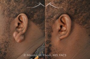 Photo of a patient before and after a procedure. Large Earlobe Keloid Removal - before and after treatment results.