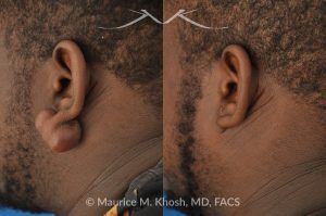Photo of a patient before and after a procedure. Large Earlobe Keloid Removal - before and after treatment results.