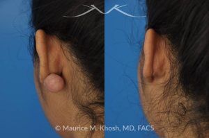 Photo of a patient before and after a procedure. Large Keloid - scar removed from the back of the ear.