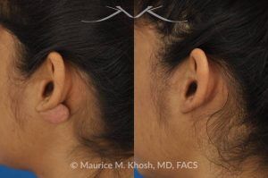 Photo of a patient before and after a procedure. Large Keloid - scar removed from the back of the ear.