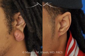 Photo of a patient before and after a procedure. Reconstruction of the ear after removing a large keloid from the earlobe - before and after treatment results.