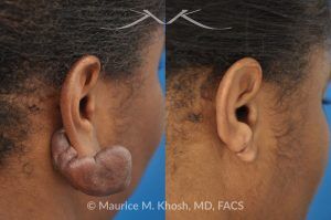 Photo of a patient before and after a procedure. Recurrent Earlobe Keloid Successfully Treated - Keloid from this earlobe had been previously excised twice. On each occasion, the keloid recurred within a few months. The keloid was surgically removed and post excision Kenalog injections have helped to prevent keloid recurrence. The picture shows one year post operative results.