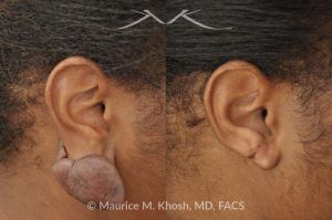 Photo of a patient before and after a procedure. Recurrent Earlobe Keloid Successfully Treated - Keloid from this earlobe had been previously excised twice. On each occasion, the keloid recurred within a few months. The keloid was surgically removed and post excision Kenalog injections have helped to prevent keloid recurrence. The picture shows one year post operative results.