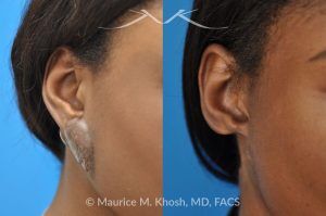 Photo of a patient before and after a procedure. Recurrent Earlobe Keloid Treated with Surgery & Radiation - This 24 year old had a keloid of the right which had been excised three times in the past. Each time the keloid recurred and became larger. She was treated with surgical excision followed by radiation therapy. The pictures depict a one year post operative result.