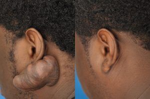 Photo of a patient before and after a procedure. Treatment of a Very Large Ear Keloid - One year post op result.