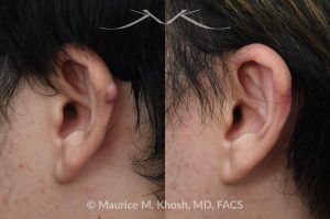 Photo of a patient before and after a procedure. Ear Keloid Removal 1 - Removal of a small l keloid along the helical rim and repair of the skin. 