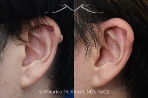 Photo of a patient before and after a procedure. Ear Keloid Removal 1 - Removal of a small l keloid along the helical rim and repair of the skin. 